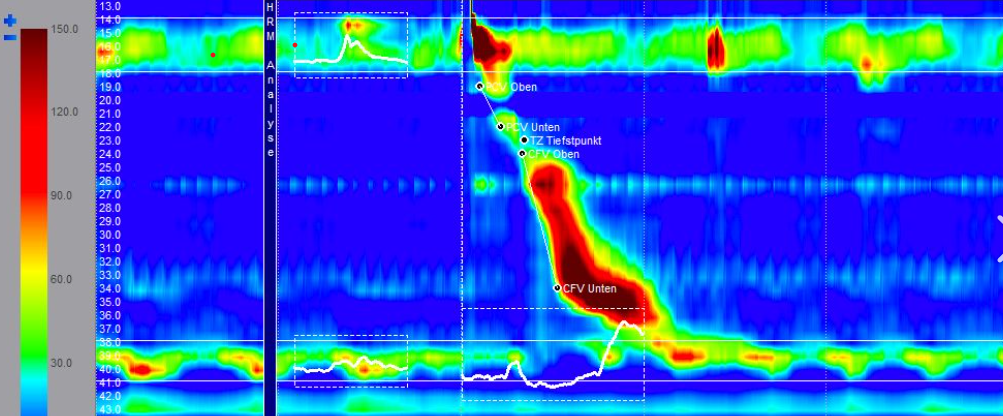 High-Resolution-Manometrie der Speiseröhre (Clouse-Plot)